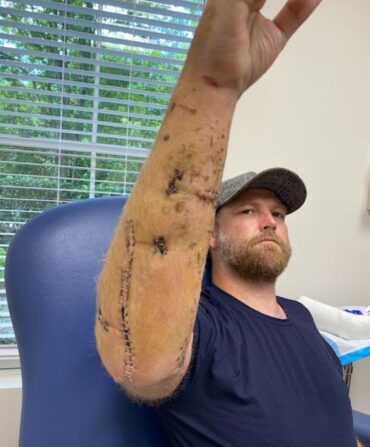 A man with gator bite marks, stitched up, on his arm